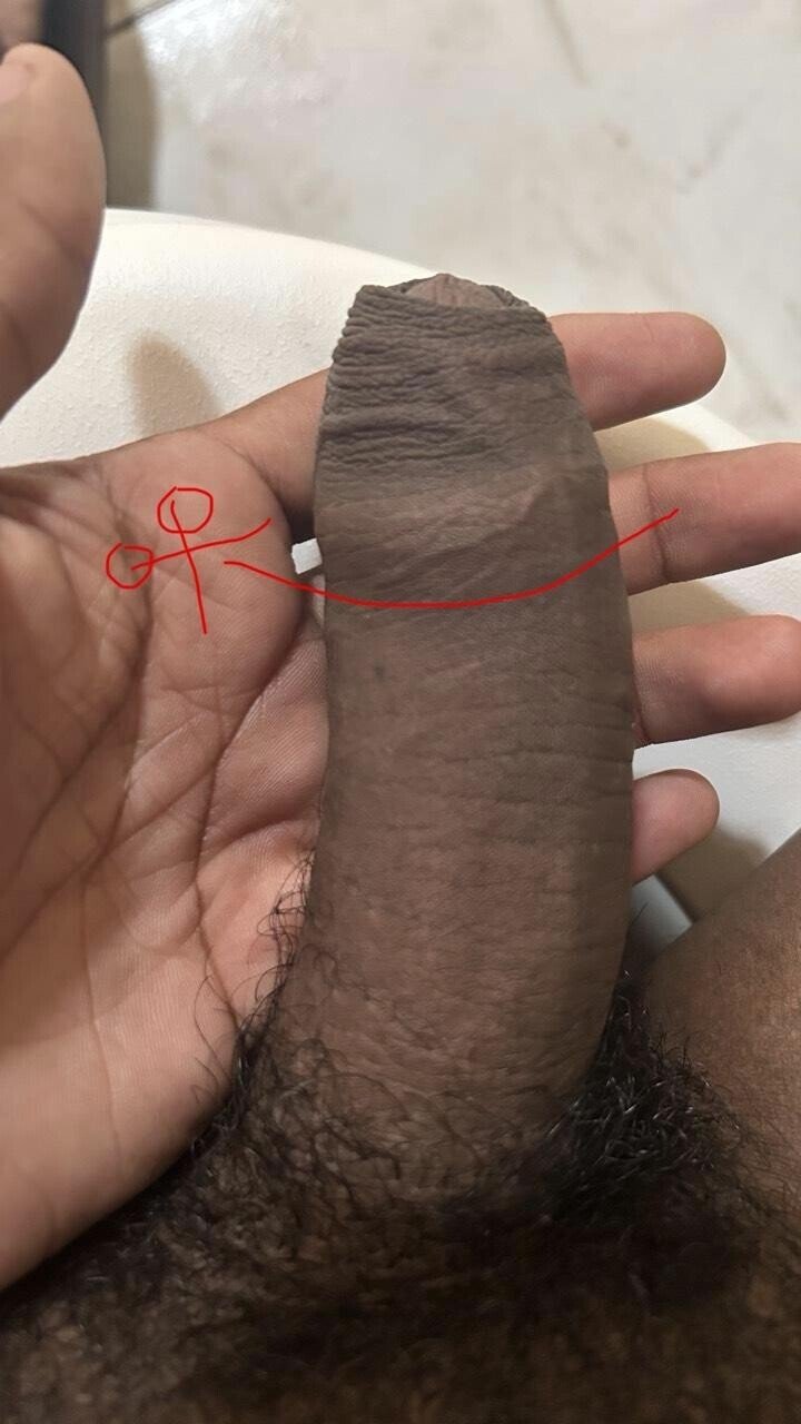 Eu já postei aqui só q sem querer apaguei. Tô pensando em fazer aquela cirurgia que remove o prepúcio só por estética — eu n tem fimose . Alguém q já fez já se arrependeu? Vale a pena fazer só por estética? Perdão se a sub não é tão recomendada pra isso. 3